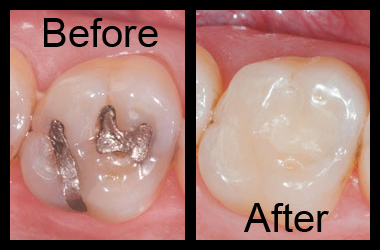 types of tooth fillings